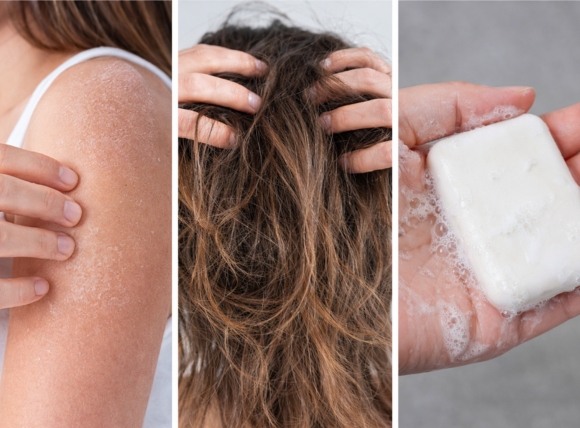 Da khô, tóc xơ và xà phòng ít bọt là biểu hiện thường gặp