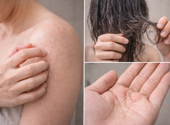 Dấu hiệu 6: Da khô ráp, ngứa ngáy; tóc xơ rối, dễ gãy rụng sau khi tắm
