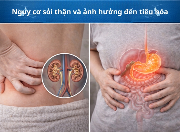 Nguy cơ sỏi thận và ảnh hưởng đến tiêu hóa