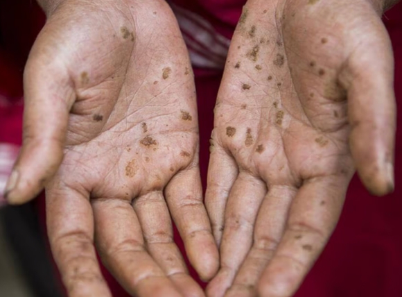 Các bệnh ngoài da do sử dụng nước giếng khoan