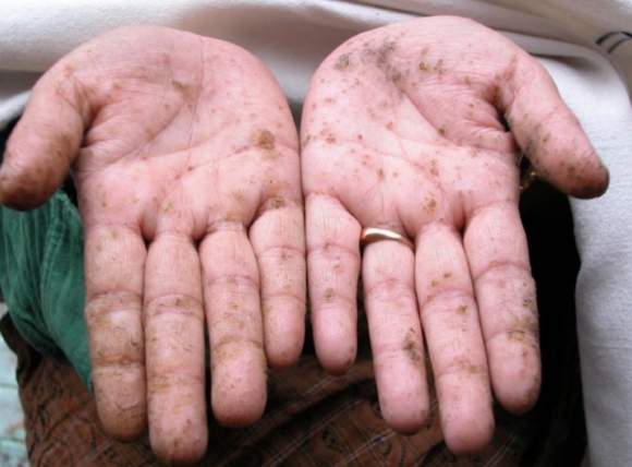 Cơ chế Asen phá hủy tế bào và gây ung thư