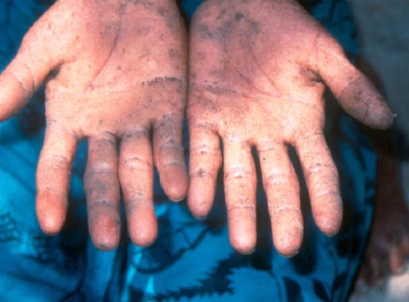 Dấu hiệu nhiễm độc Asen trên da