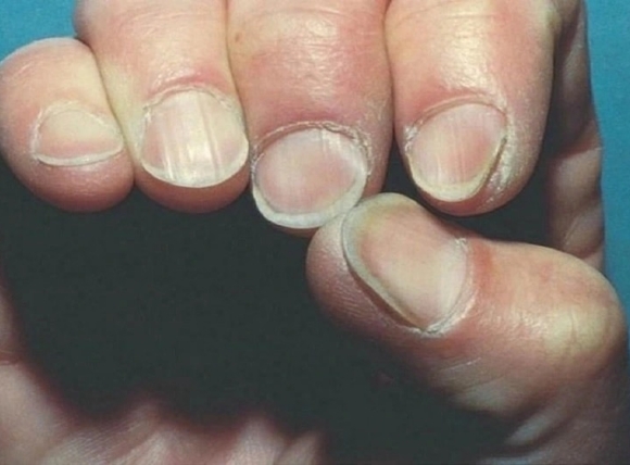 Dấu hiệu nhiễm độc Asen trên móng tay