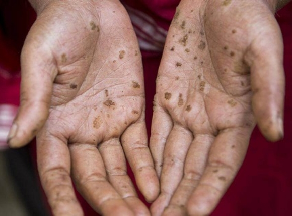 Thời gian phát bệnh ung thư do phơi nhiễm Asen