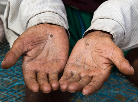 Triệu chứng toàn thân do nhiễm độc Asen