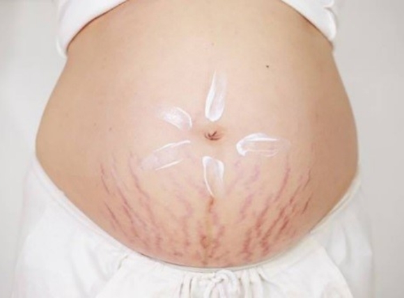 Bổ sung nước sạch cải thiện làn da và giảm rạn da