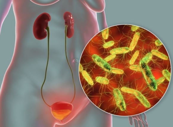 E.coli trong nước giếng gây nhiễm trùng đường tiết niệu (UTI)
