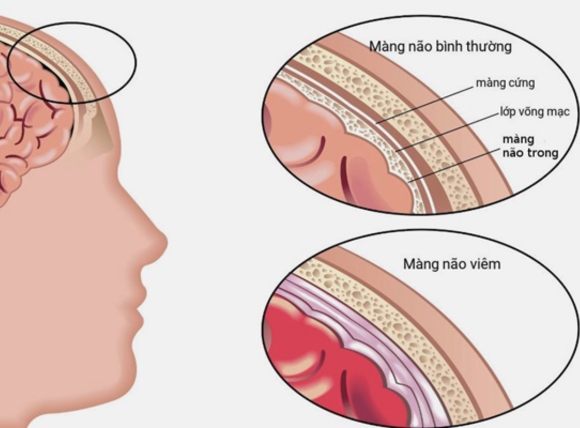 E.coli trong nước giếng gây viêm màng não ở trẻ sơ sinh và trẻ nhỏ