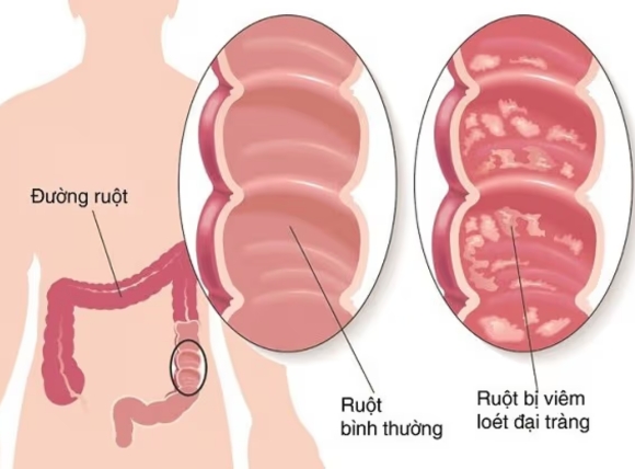 E.coli trong nước giếng gây tiêu chảy nặng và viêm đại tràng xuất huyết