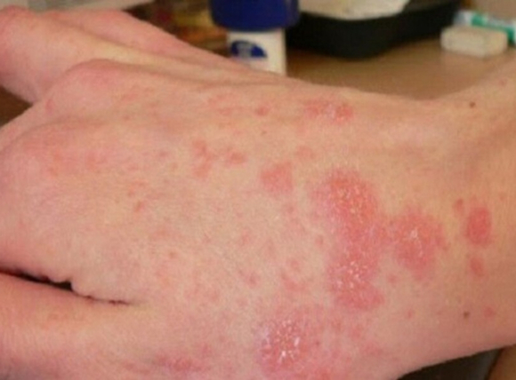 nuoc-phen-anh-huong-den-suc-khoe-va-sinh-hoat