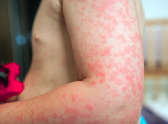 Trẻ sơ sinh và trẻ nhỏ bị ảnh hưởng khi dùng nước giếng không lọc