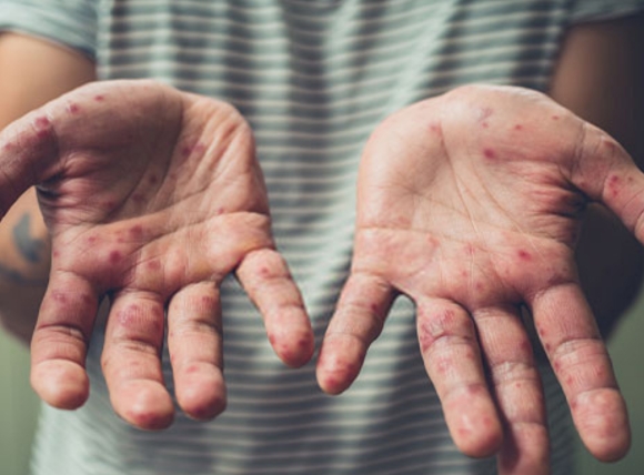 Thực trạng sử dụng nước giếng nhiễm sắt tại Việt Nam