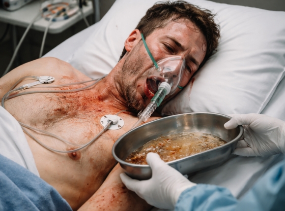 Triệu chứng cấp tính khi tiếp xúc Asen nồng độ cực cao