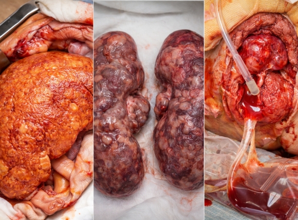 Suy gan, suy thận và tổn thương hệ bài tiết