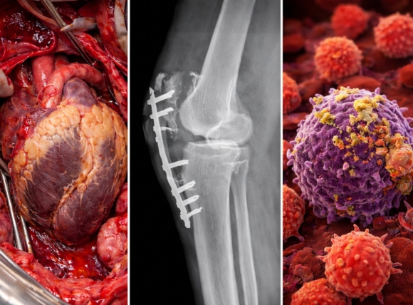 Tổn thương hệ tuần hoàn, xương và hệ miễn dịch