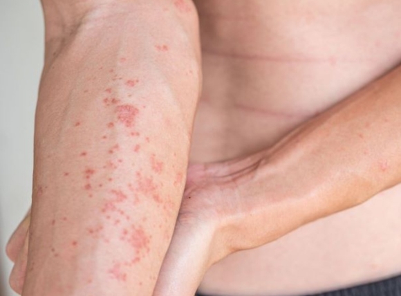 Tác hại của nước phèn đối với sức khỏe